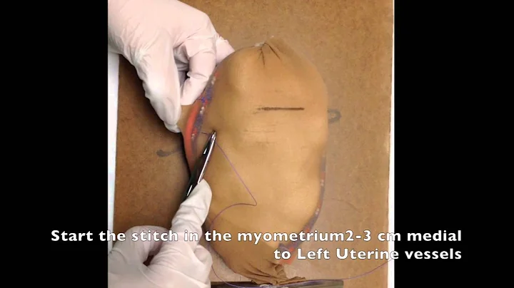 O’Leary Stitch for Uterine artery ligation