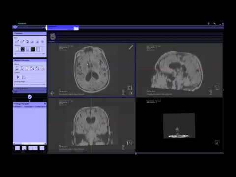 ACR HII TBI Project Demo