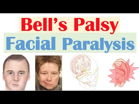 Bell’s Palsy (Facial Paralysis) | Causes, Pathophysiology, Signs & Symptoms, Diagnosis, Treatment