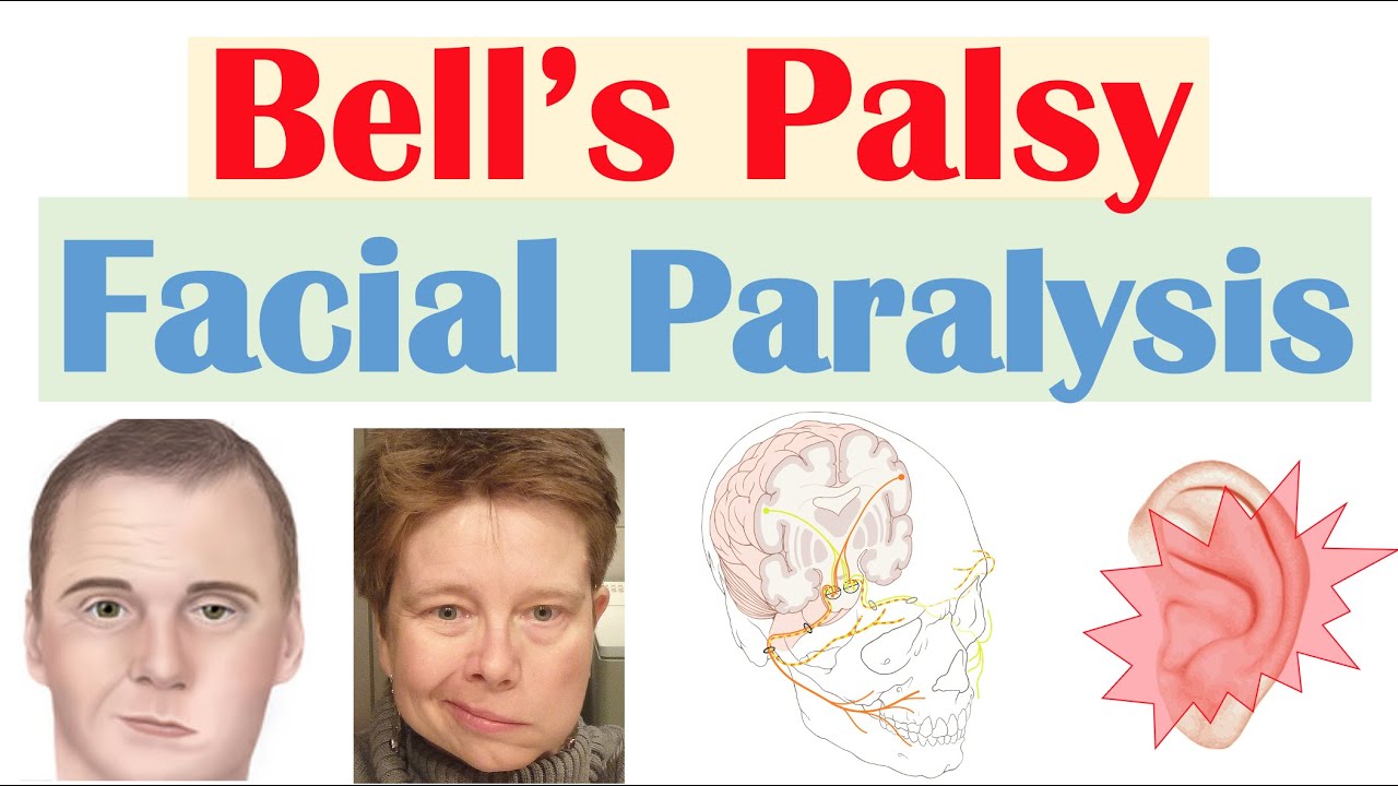Bell s Palsy Facial Paralysis Causes Pathophysiology Signs Bell s Palsy Facial Paralysis Causes Pathophysiology Signs