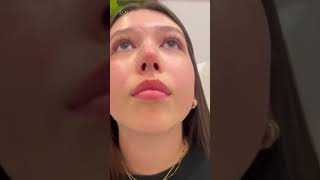 6 month Post Op Rhinoplasty #beforeandafter #plasticsurgeon