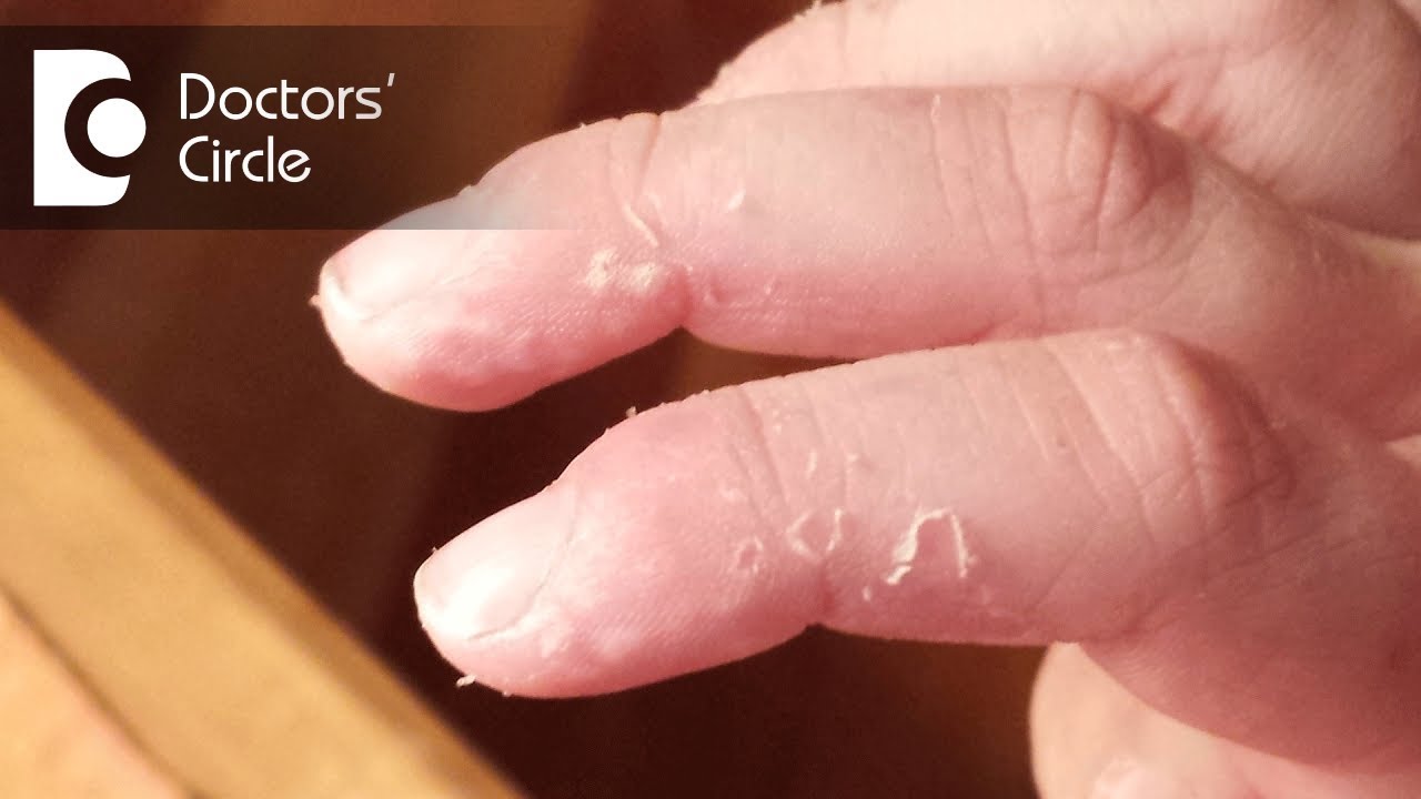 Are you tired of skin around nails peeling? 9 tips to deal with it |  HealthShots