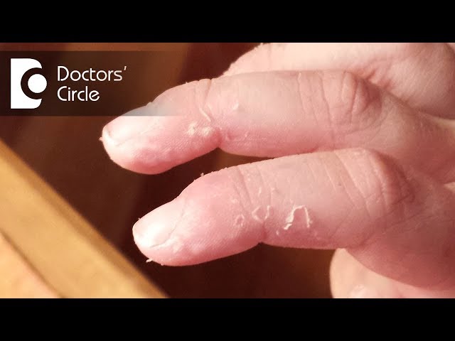 Understanding Skin Peeling Between Toes - ePodiatrists