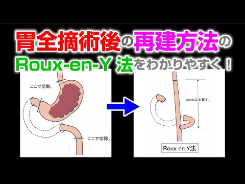 胃全摘術後の再建方法のroux En Y法をわかりやすく Youtube 胃全摘術後の再建方法のroux En Y法をわかりやすく Youtube