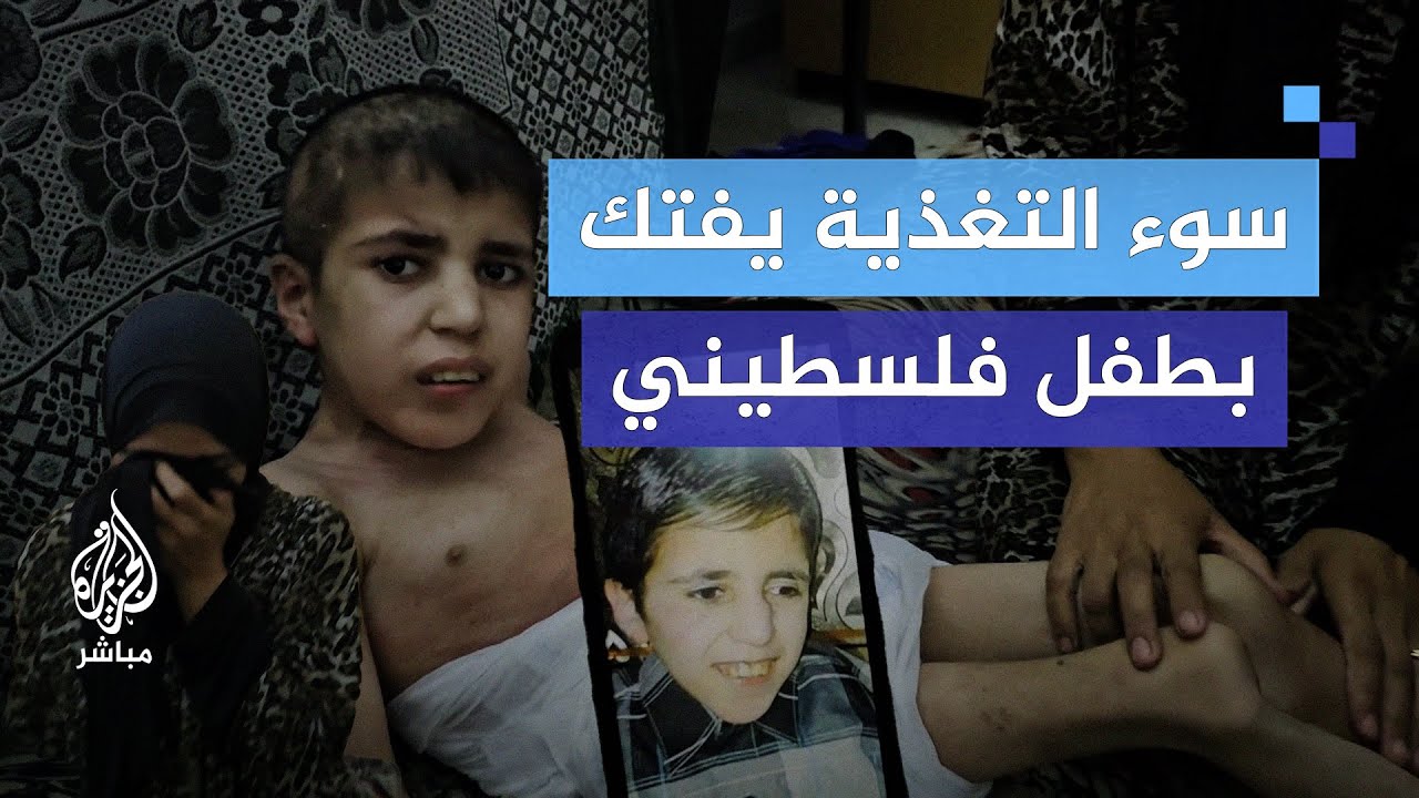 من 50 كغ إلى 18 كغ.. سوء التغذية يفتك بطفل فلسطيني