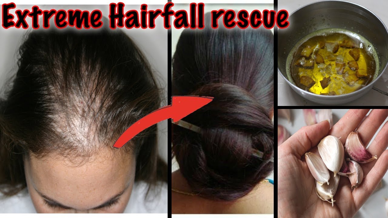8 Causes Of Hair Fall In Pregnancy And Remedies To Control