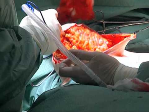 absentismo laboral La exposición a humos y gases de diatermia quirúrgica