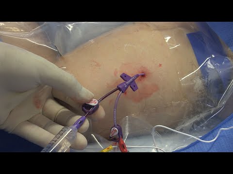 Video: ¿Cómo retirar un catéter central insertado periféricamente?