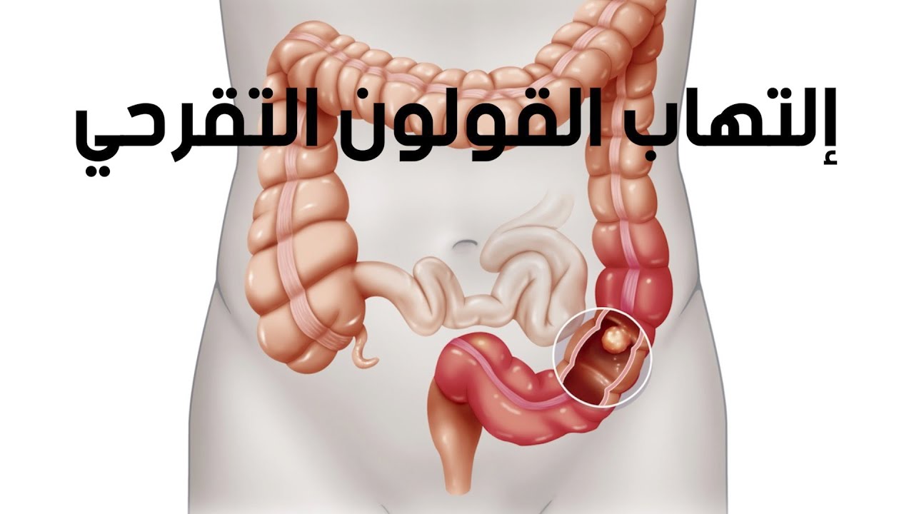 تقرحات القولون