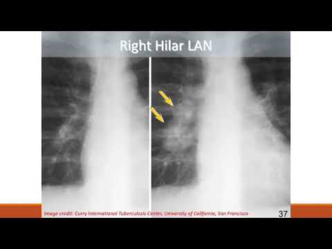 Gambaran Radiologi TB Paru - YouTube