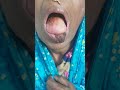 Lip Cancer #fashion #cancer #doctor