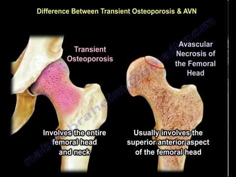 Transient Osteoporosis of the hip - Everything You Need To Know - Dr. Nabil Ebraheim