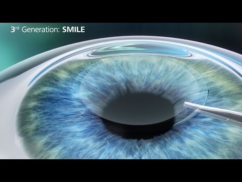 ReLEx SMILE Procedure