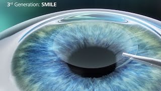 ReLEx SMILE Procedure - Willis Knighton Health