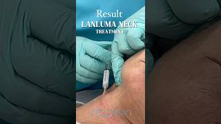 Lanluma Neck Treatment Result