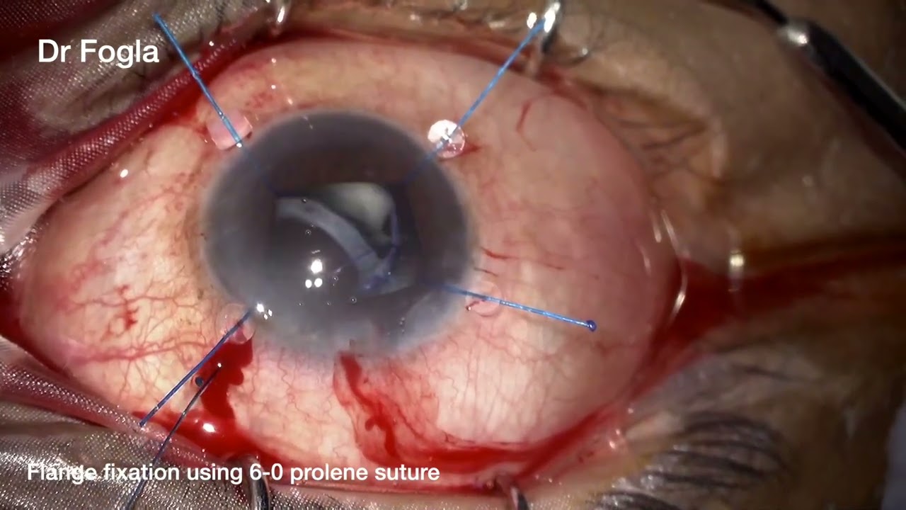 Flange IOL fixation of subluxated IOL bag complex