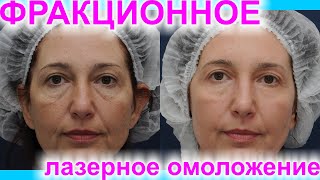 видео: Фракционная лазерная шлифовка лица. Развенчиваем мифы. Комментарии пациентки. Результат До/После! #3 картинка: Фракционная лазерная шлифовка лица. Развенчиваем мифы. Комментарии пациентки. Результат До/После! #3
