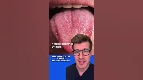 Signs of IRON DEFICIENCY ANAEMIA in the TONGUE | Glossitis explained #shorts  #health #anaemia