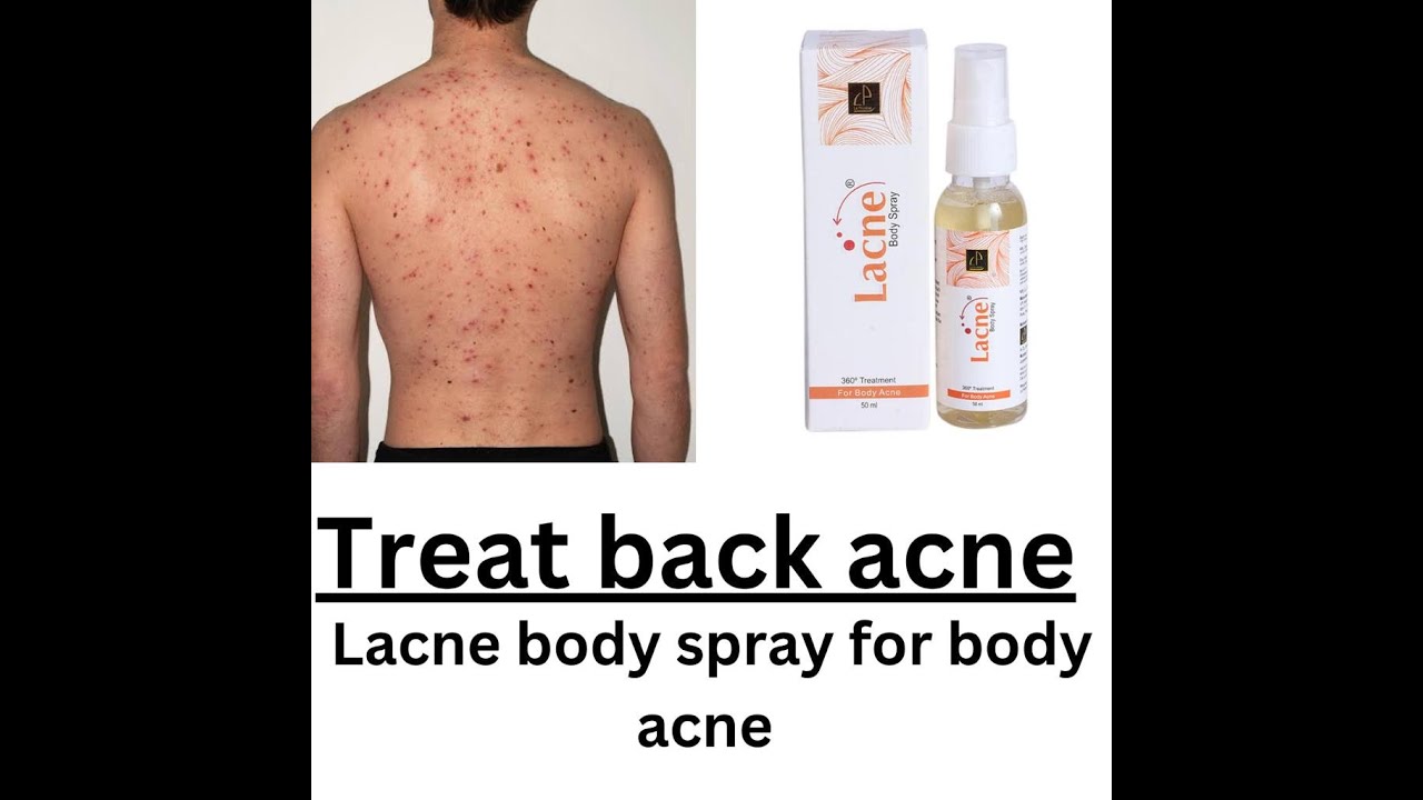 l-lacne-body-spray-l-treat-back-acne-l-review-in