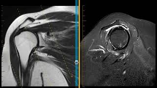 Shoulder Impingement With Rotator Cuff Tendinopathy And Labral Tear