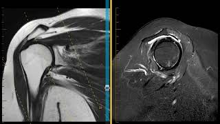 Shoulder impingement with rotator cuff tendinopathy and labral tear