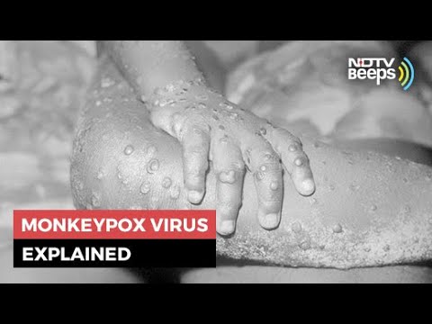 Monkeypox: 5 Things You Should Know About This Rare Virus