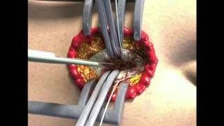 ATLS DPL (Diagnostic peritoneal lavage)