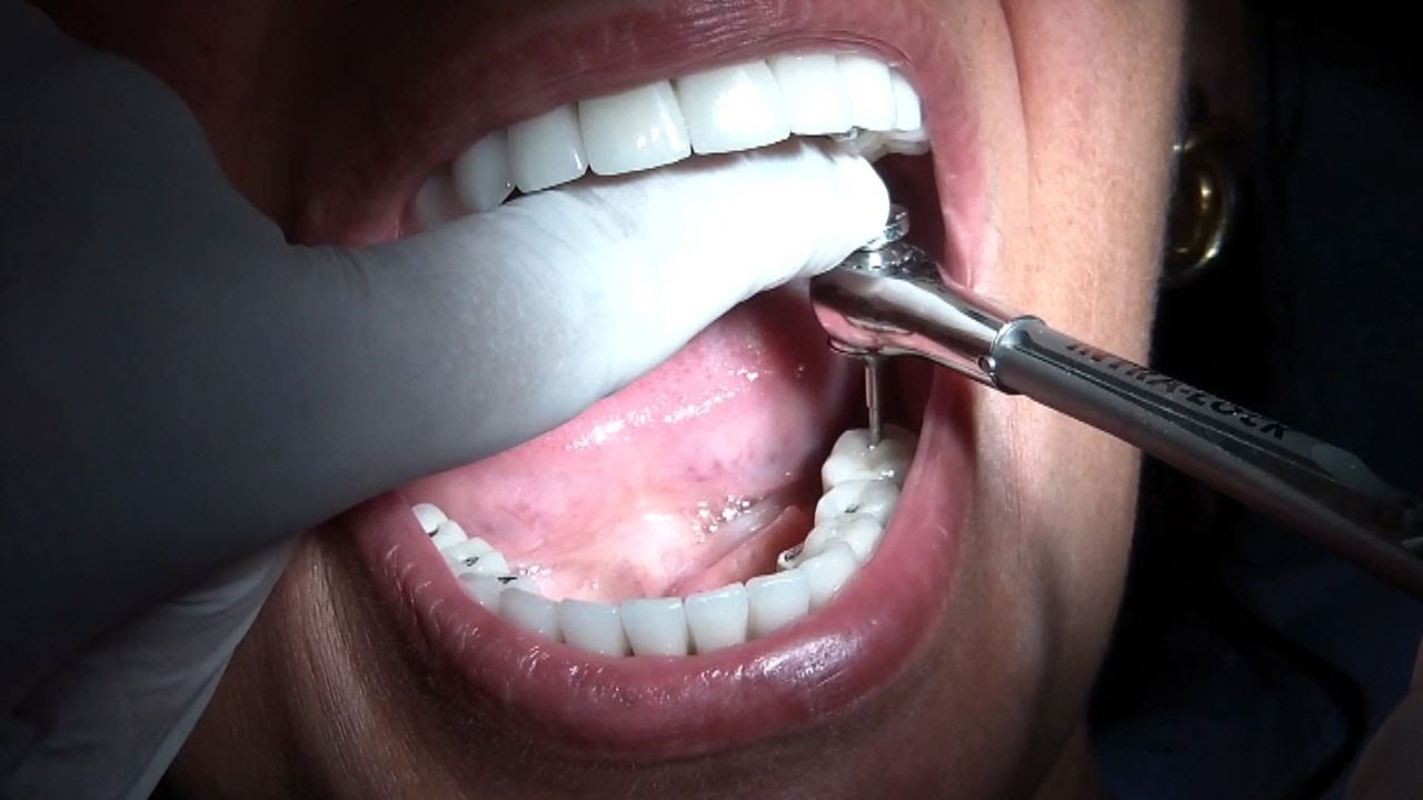 Full Mouth Implant 86