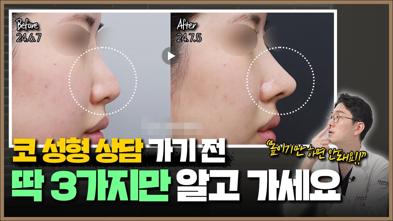 코 수술 전 딱 세 가지만 알고 가세요!! 이것만 알아도 코 재수술 피할 수 있습니다!! - YouTube