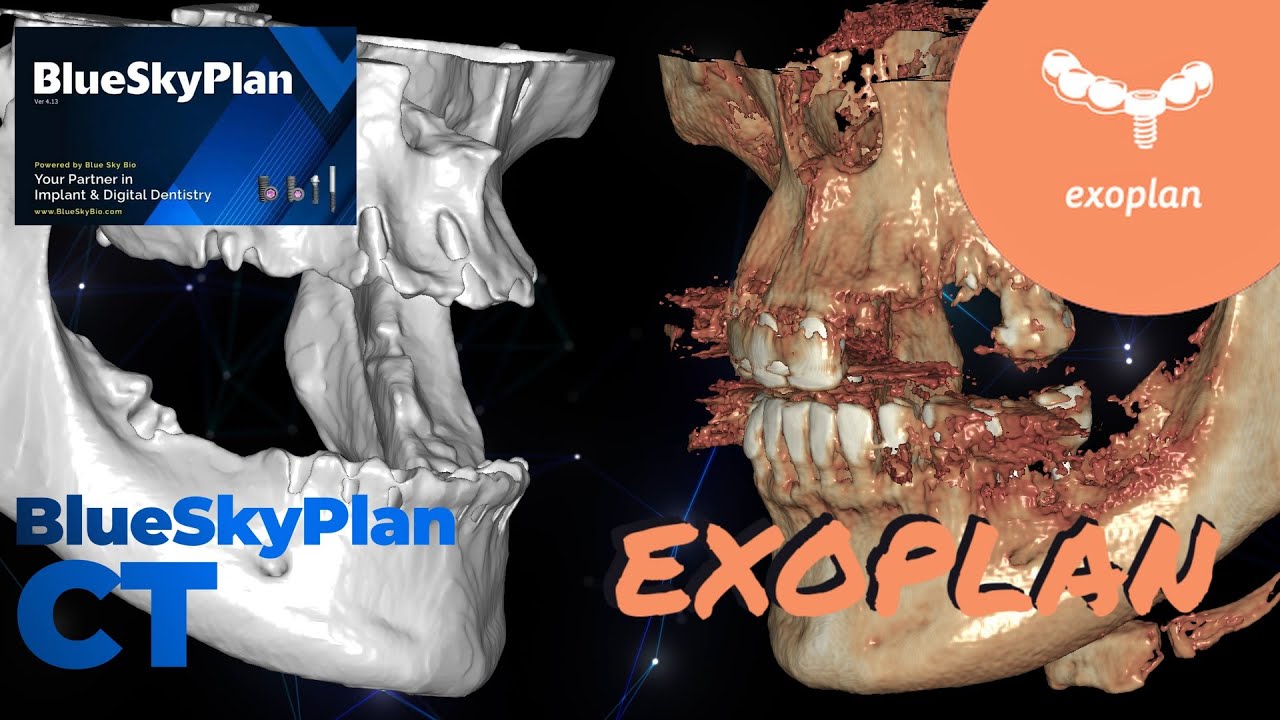 ExoPlan & Blue Sky Plan #exoplan #exocad #blueskyplan