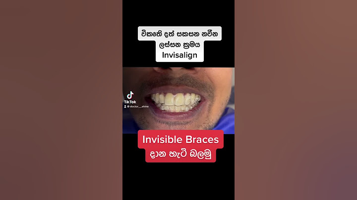 විකෘති දත් දැන් ඔබට පහසුවෙන් සකසා ගත හැකි invisible braces දාන හැටි බලමු #shorts #invisalignsmile
