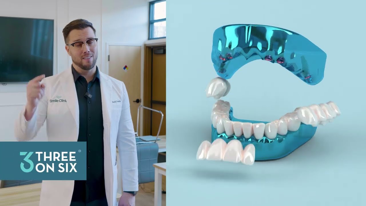 Система 3 на 6 минимизирует потерю костной массы, в отличие от системы All-on-4.