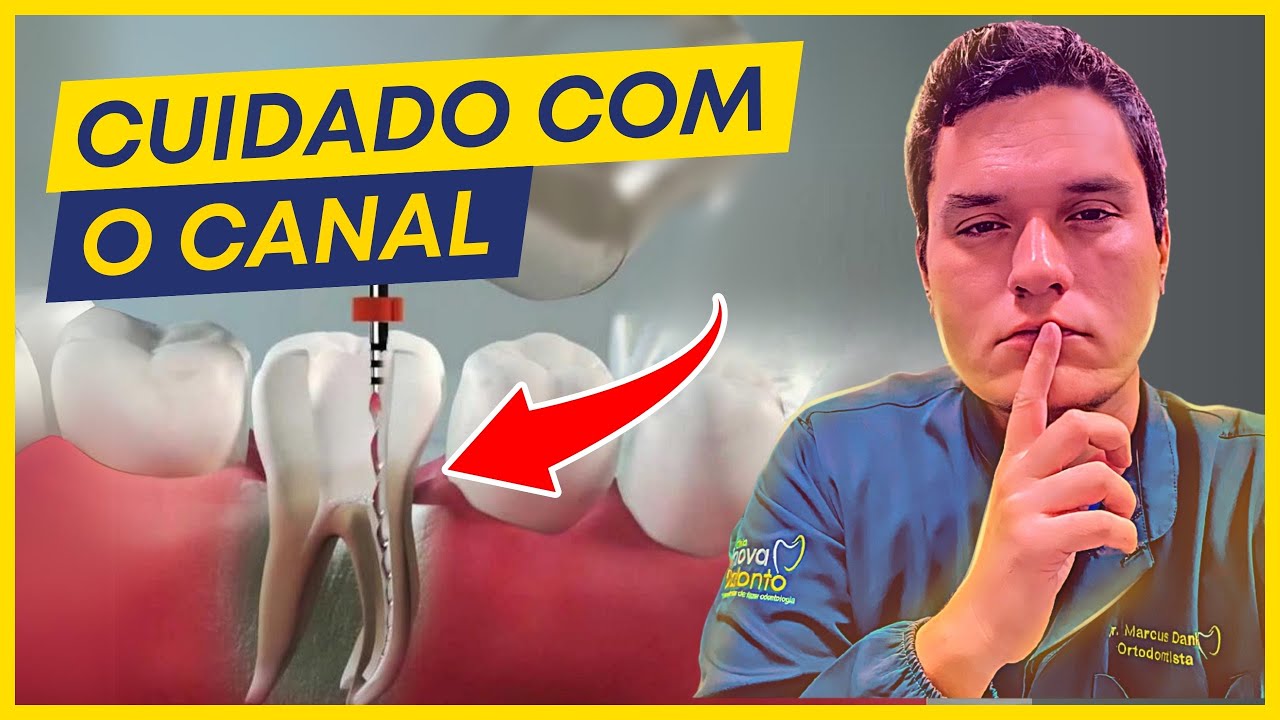 10 Perigos OCULTOS do TRATAMENTO DE CANAL (Que você não sabia).
