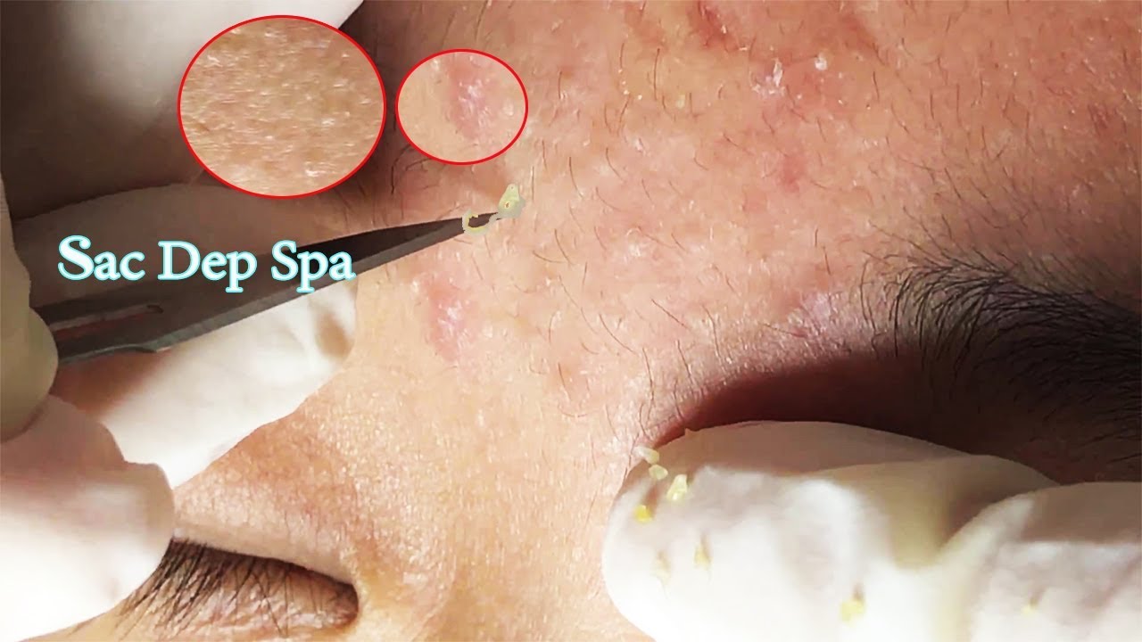 Knife Skills To Remove Acne | Kỹ Thuật Lấy Mụn Ẩn Tại Sắc Đẹp Spa