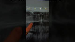 My sinus surgery recovery journey #vlog #surgeryrecovery #dayinthelife