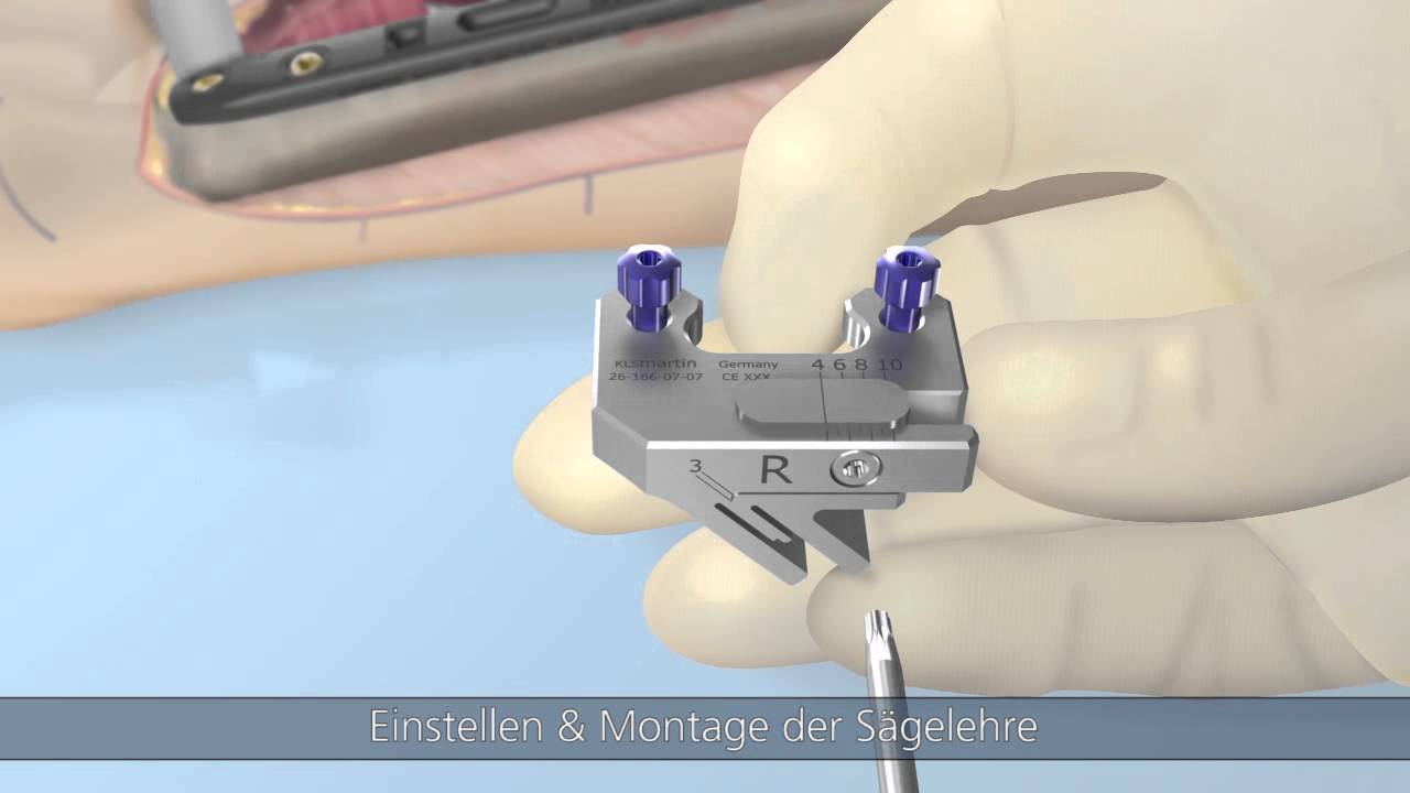 recos-ulnaverk-rzung-von-kls-martin-youtube