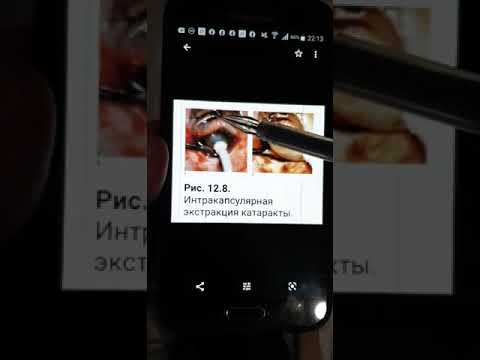 Хирургия катаракты - обзор. Часть 2