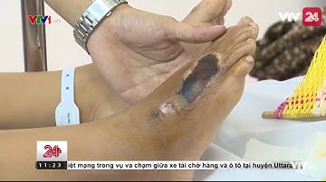 Gia tăng trẻ bị rắn cắn mùa mưa - Tin Tức VTV24