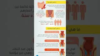 علاج البواسير