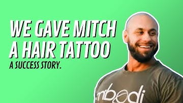 How I Got the Ultimate Hairline Transformation with SMP - See My Incredible Before & After Results!