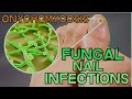 ONYCHOMYCOSIS - FUNGAL NAIL INFECTION - DEFINITION, SYMPTOMS, TREATMENT - EXPLAINED in 5 Minutes!!