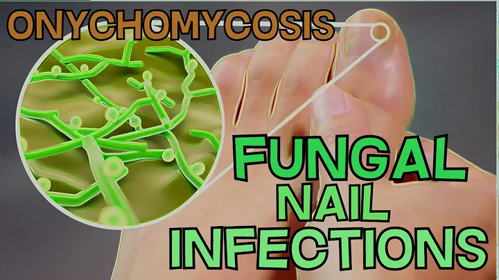 ONYCHOMYCOSIS - FUNGAL NAIL INFECTION - DEFINITION, SYMPTOMS, TREATMENT - EXPLAINED in 5 Minutes!! - DayDayNews