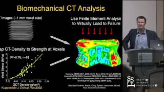 Pre-Operative Bone Strength & BMD Assessment in Spine Fusion Patients by Tony Keaveny, Ph.D. screenshot 3