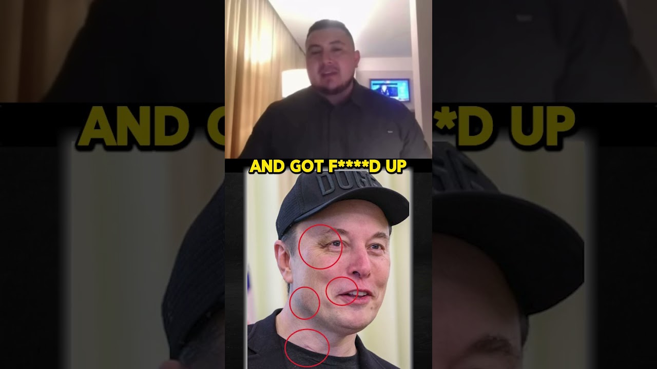 Elon Musk Joined The BLACK EYE CLUB!?!