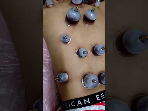 خير ما تداويتم به الحجامه 