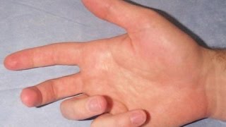 Quick Self-Test for Dupuytren’s Contracture