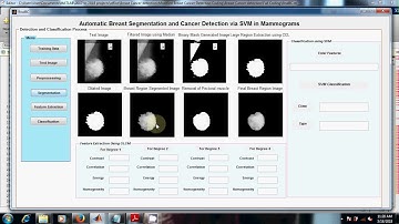 Automatic Breast Segmentation and Cancer Detection via SVM in Mammograms | MATLAB Project