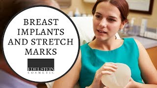 Breast Implants And Stretch Marks Edelstein Cosmetic