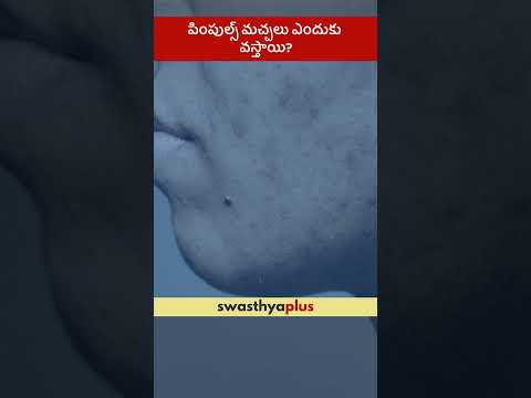 పింపుల్స్ మచ్చలు ఎందుకు వస్తాయి? | What causes Acne Scar? | Dr Neethu Chowdary K