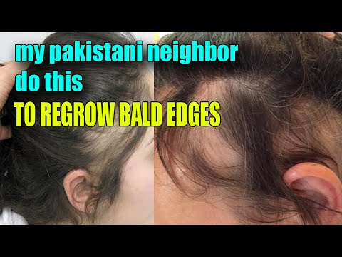 my pakistani neighbor do this TO REGROW BALD EDGES | Regrow thinning natural 5c hair FAST
